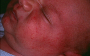 acné neonatal
